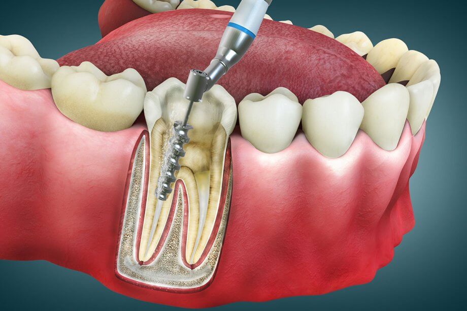 How Long Does A Root Canal Take?